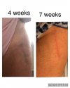 [Bonesmart.org] Hippies scars - post your badges of honor here: NO CHIT-CHAT HERE PLEASE