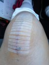 [Bonesmart.org] Surgery Done  August 10th, 2022