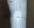 [Bonesmart.org] Hey Jude knee replacement