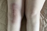 [Bonesmart.org] Hey Jude knee replacement