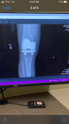 [Bonesmart.org] TKR on 8/8/22