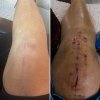 [Bonesmart.org] TKR 2 Years Out