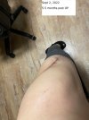 [Bonesmart.org] Lateral pelvic tilt and real LLD (7mm)