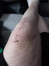 [Bonesmart.org] Knee Scars - Post Your Badges of Honor Here! NO CHIT-CHAT please
