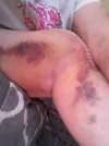 [Bonesmart.org] Knee Scars - Post Your Badges of Honor Here! NO CHIT-CHAT please