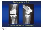 [Bonesmart.org] TKR on 8/8/22