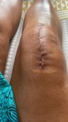 [Bonesmart.org] Knee Scars - Post Your Badges of Honor Here! NO CHIT-CHAT please