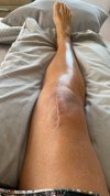 [Bonesmart.org] Knee Scars - Post Your Badges of Honor Here! NO CHIT-CHAT please