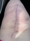 [Bonesmart.org] Knee Scars - Post Your Badges of Honor Here! NO CHIT-CHAT please