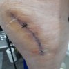 [Bonesmart.org] Hippies scars - post your badges of honor here: NO CHIT-CHAT HERE PLEASE