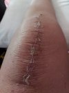 [Bonesmart.org] Knee Scars - Post Your Badges of Honor Here! NO CHIT-CHAT please