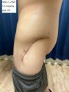 [Bonesmart.org] Hippies scars - post your badges of honor here: NO CHIT-CHAT HERE PLEASE