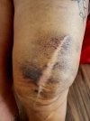 [Bonesmart.org] Complex surgery with revisions, infection, sepsis, and more…