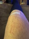 [Bonesmart.org] Knee Scars - Post Your Badges of Honor Here! NO CHIT-CHAT please
