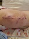 [Bonesmart.org] Knee Scars - Post Your Badges of Honor Here! NO CHIT-CHAT please