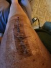 [Bonesmart.org] Knee Scars - Post Your Badges of Honor Here! NO CHIT-CHAT please