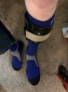 [Bonesmart.org] First TKR and now Spinal Fusion