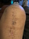 [Bonesmart.org] Abdominal muscle pain