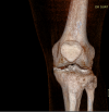 [Bonesmart.org] TKR after tibial plateau fracture