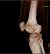 [Bonesmart.org] TKR after tibial plateau fracture