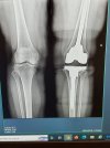 [Bonesmart.org] Partial Revision Failure