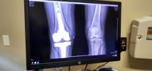 [Bonesmart.org] Agilitymom's revision recovery<<