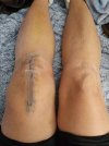 [Bonesmart.org] Knee Scars - Post Your Badges of Honor Here! NO CHIT-CHAT please
