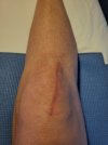 [Bonesmart.org] Knee Scars - Post Your Badges of Honor Here! NO CHIT-CHAT please