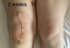 [Bonesmart.org] Knee Scars - Post Your Badges of Honor Here! NO CHIT-CHAT please