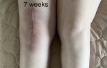 [Bonesmart.org] Knee Scars - Post Your Badges of Honor Here! NO CHIT-CHAT please