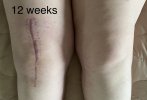 [Bonesmart.org] Knee Scars - Post Your Badges of Honor Here! NO CHIT-CHAT please