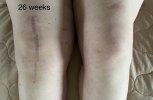 [Bonesmart.org] Knee Scars - Post Your Badges of Honor Here! NO CHIT-CHAT please
