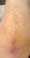 [Bonesmart.org] Knee Scars - Post Your Badges of Honor Here! NO CHIT-CHAT please