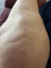 [Bonesmart.org] Knee Scars - Post Your Badges of Honor Here! NO CHIT-CHAT please
