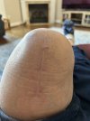 [Bonesmart.org] Knee Scars - Post Your Badges of Honor Here! NO CHIT-CHAT please