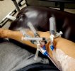 [Bonesmart.org] Complex surgery with revisions, infection, sepsis, and more…