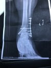 [Bonesmart.org] Ankle Injury Recovery encouragement