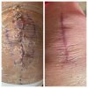 [Bonesmart.org] Knee Scars - Post Your Badges of Honor Here! NO CHIT-CHAT please