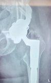 [Bonesmart.org] Complex surgery with revisions, infection, sepsis, and more…