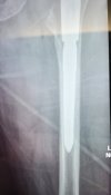 [Bonesmart.org] Complex surgery with revisions, infection, sepsis, and more…