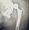 [Bonesmart.org] Complex surgery with revisions, infection, sepsis, and more…