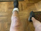 [Bonesmart.org] My LTKR journey