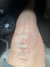 [Bonesmart.org] Knee Scars - Post Your Badges of Honor Here! NO CHIT-CHAT please