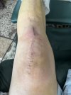 [Bonesmart.org] Knee Scars - Post Your Badges of Honor Here! NO CHIT-CHAT please