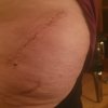 [Bonesmart.org] Hippies scars - post your badges of honor here: NO CHIT-CHAT HERE PLEASE