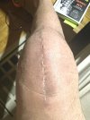 [Bonesmart.org] Knee Scars - Post Your Badges of Honor Here! NO CHIT-CHAT please