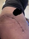 [Bonesmart.org] Hippies scars - post your badges of honor here: NO CHIT-CHAT HERE PLEASE