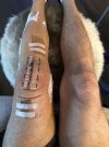 [Bonesmart.org] Knee Scars - Post Your Badges of Honor Here! NO CHIT-CHAT please
