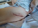 [Bonesmart.org] Hippies scars - post your badges of honor here: NO CHIT-CHAT HERE PLEASE