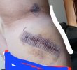 [Bonesmart.org] Hippies scars - post your badges of honor here: NO CHIT-CHAT HERE PLEASE